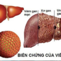 VIÊM GAN SIÊU VI B